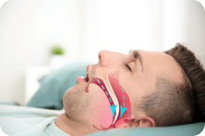 Upper Airway Resistance Syndrome